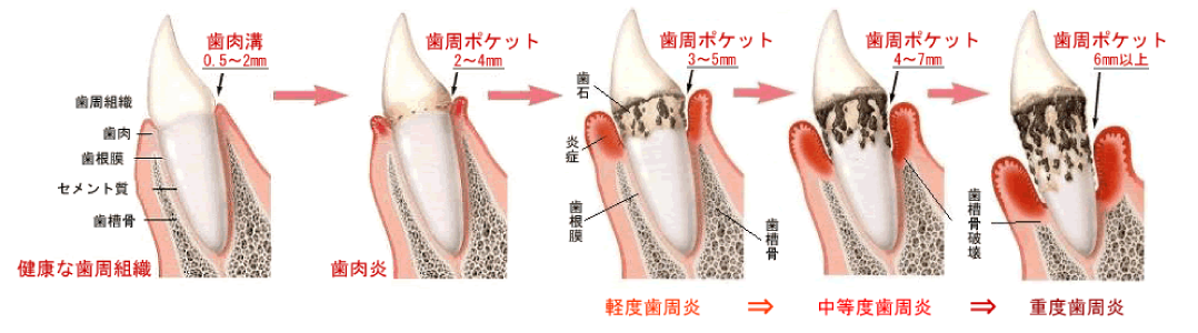 歯周病の進行を表した図