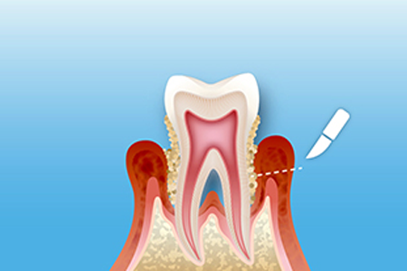 歯周外科治療のイラスト