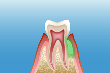歯周再生療法適用箇所