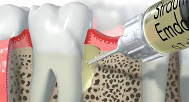 歯周再生療法のCG画像